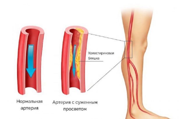 Атеросклероз сосудов: невидимая угроза, о которой должен знать каждый