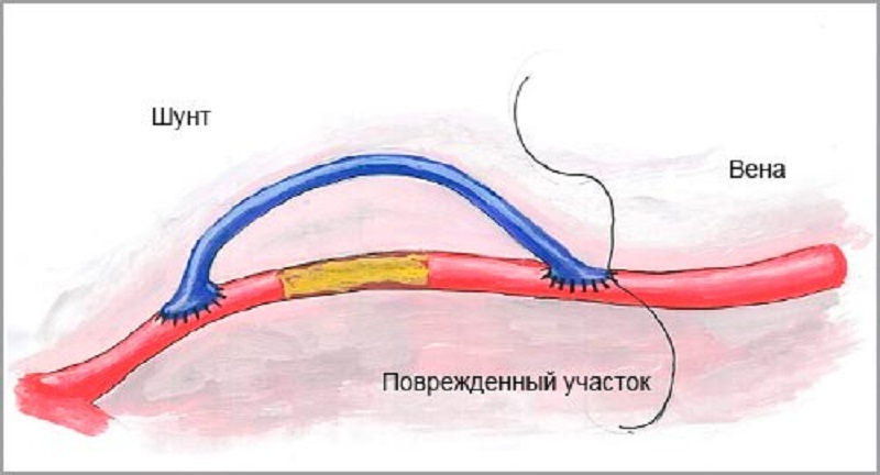 Как выглядит шунт. Шунтирование коронарных артерий. Шунтирование, стентирование артерий. Шунтирование сосудов сердца стент. Шунтирование кровеносных сосудов.