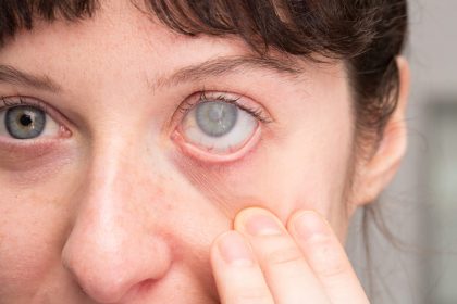 Бельмо на глазу: причины, симптомы, лечение