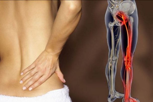 Как справиться с защемлением седалищного нерва