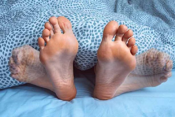 Что такое болезнь Экбома