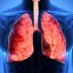 Как распознать туберкулез легких