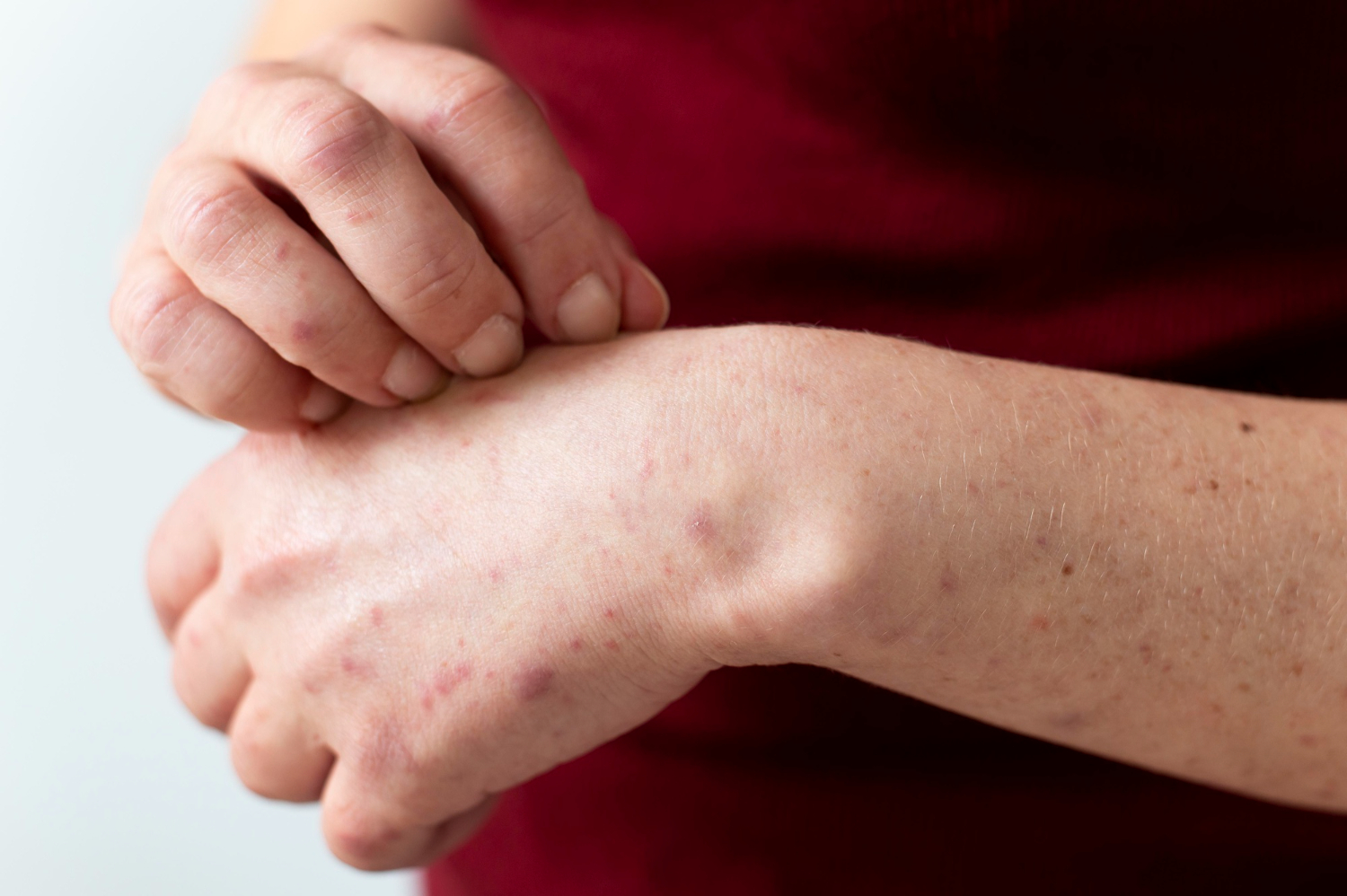 Stress Hives and Rashes