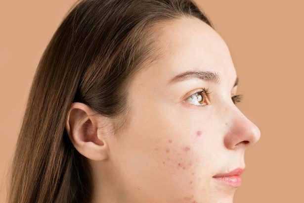 В чем разница между кистозными и гормональными прыщами?