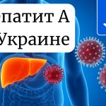 Вспышка гепатита А в Киеве: что известно и как защитить здоровье