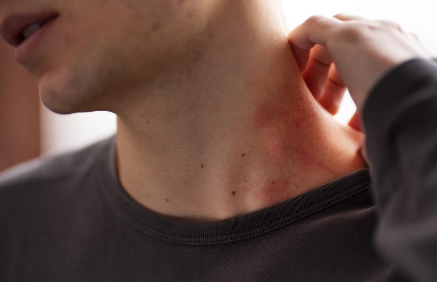 В Днепре зафиксирован всплеск кори: как защитить здоровье?