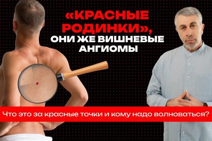 Доктор Комаровский объяснил, что означают красные точки на коже и когда вишневые ангиомы требуют проверки