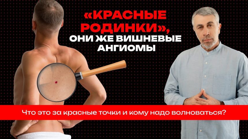 Доктор Комаровский объяснил, что означают красные точки на коже и когда вишневые ангиомы требуют проверки